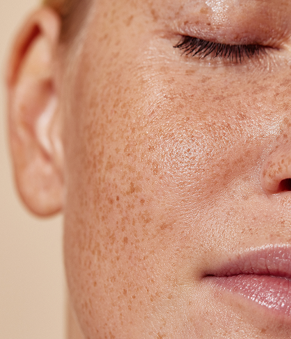 Dr. Tea Rosović o prevenciji i liječenju zloćudnog tumora: "Zabrinjavajuća je incidencija melanoma kod mladih ljudi"